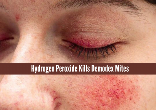 Hydrogen Peroxide Kills Demodex Mites