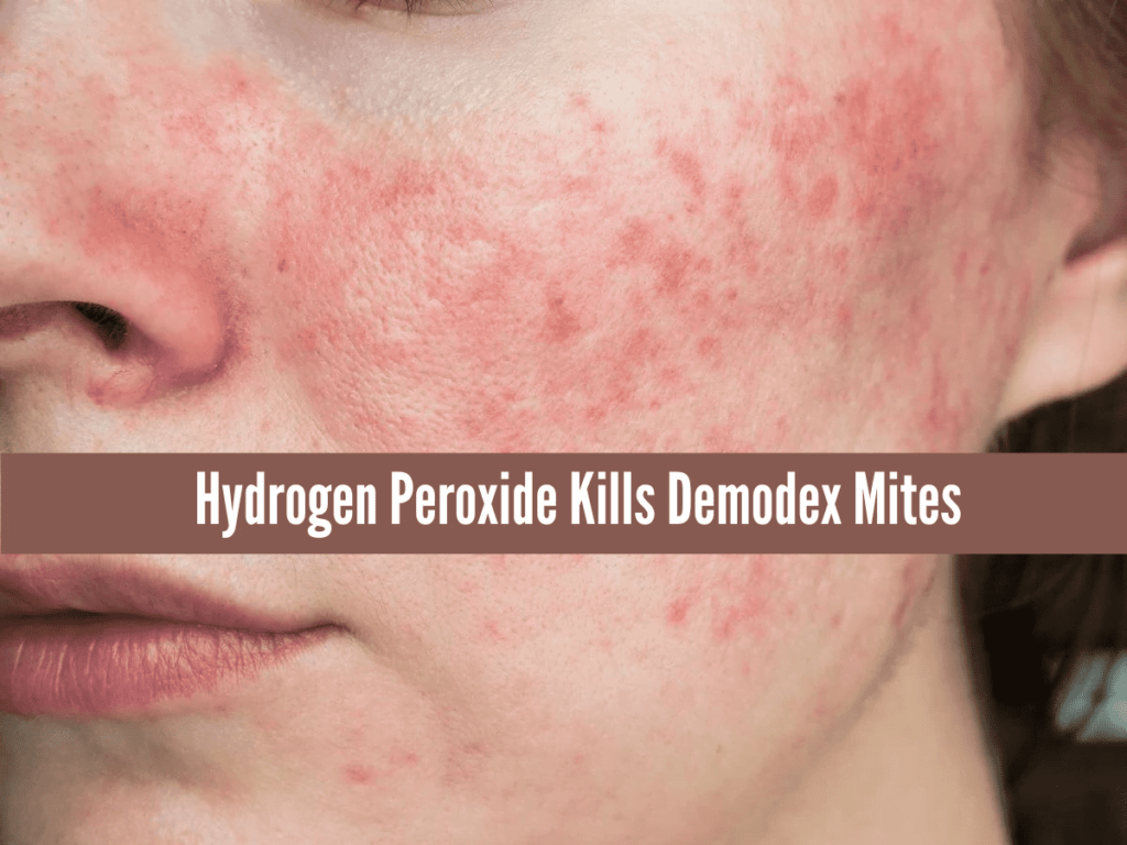 Hydrogen Peroxide Kills Demodex Mites