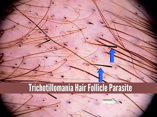 Trichotillomania Hair Follicle Parasite