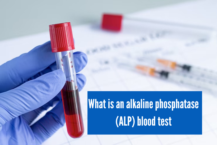 What Level of Alkaline Phosphatase is Dangerous, What is an alkaline phosphatase (ALP) blood test