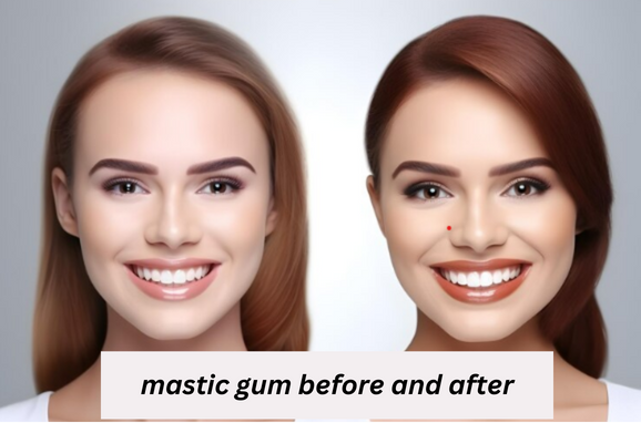 Mastic Gum Before And After