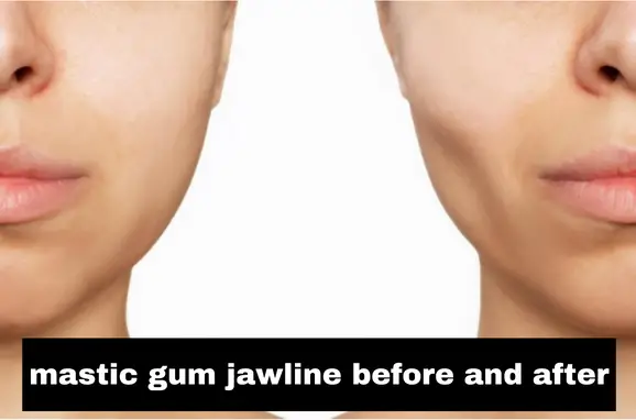 Mastic Gum Before And After,