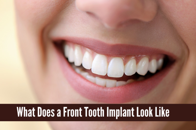 what does a tooth implant look like, what does a tooth implant look like