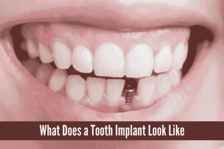 what does a tooth implant look like, what does a tooth implant look like