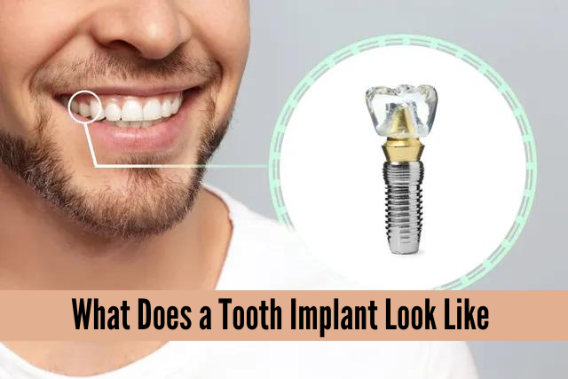 what does a tooth implant look like