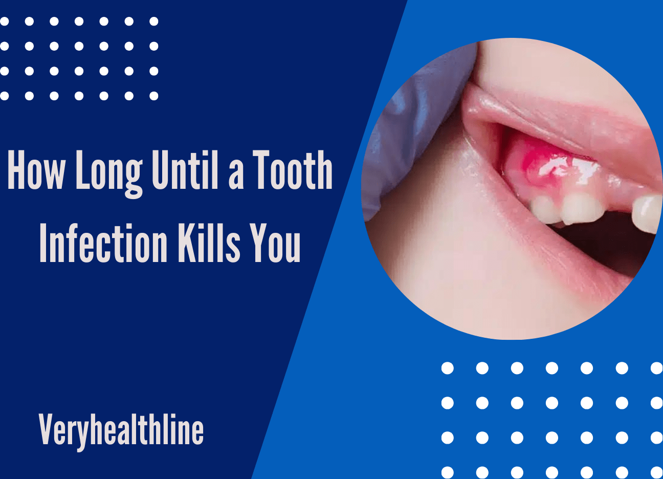 how long until a tooth infection kills you